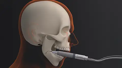 Mandibular angle ostectomy