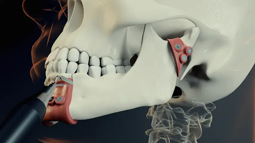 Mandibulotomy and mandibulectomy/maxillectomy