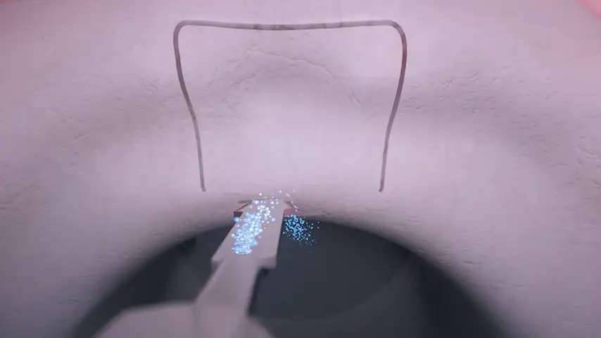 Exceptional precision
