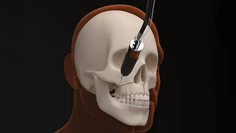Surgically assisted rapid palatal expansion