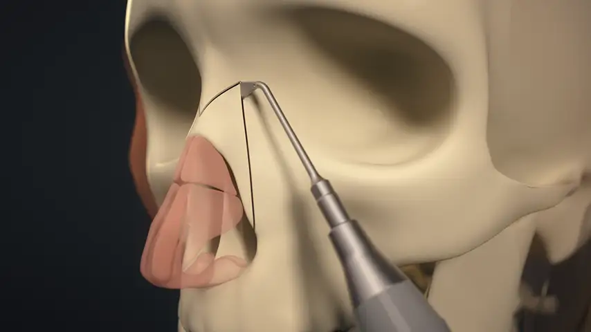 Medial, transverse, and lateral osteotomies