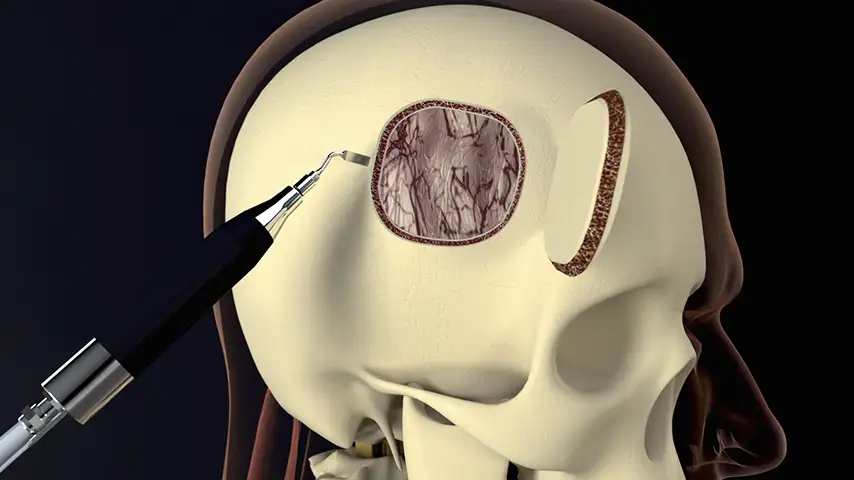 Craniotomy and craniectomy