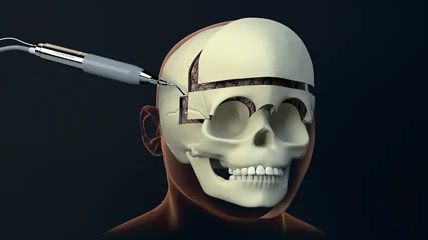 Cranioplasty and reshaping