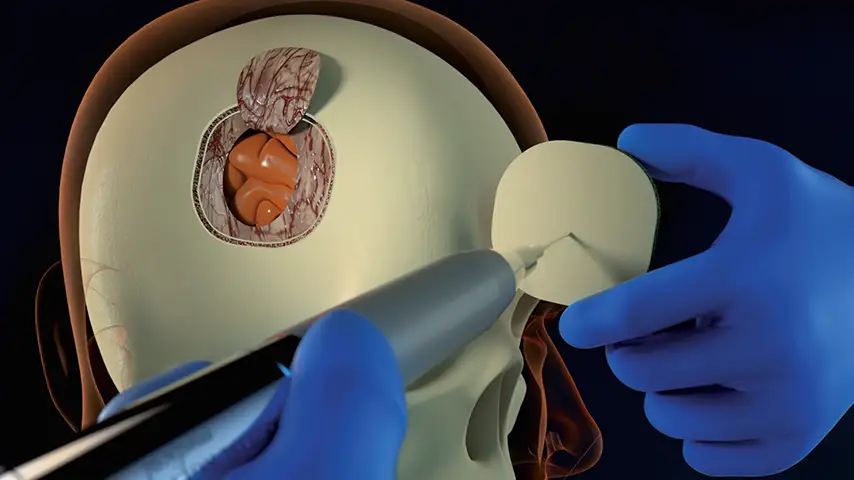 Drilling a hole for dural suspension