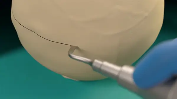 Micrometric cut