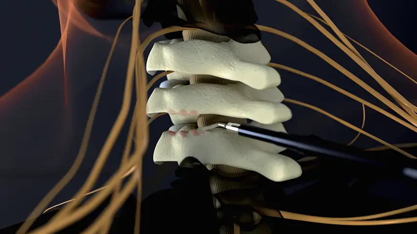 Cavitation Effect